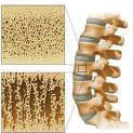 Biopolymer-containing calcium phosphate foam for bone regeneration